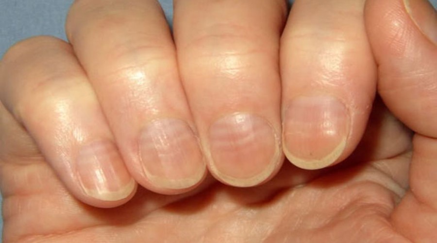 Внешний вид ногтей иногда указывает на больную щитовидную железу