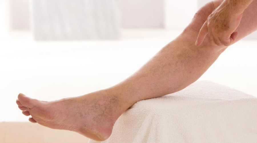 Внезапные судороги ног могут означать варикоз