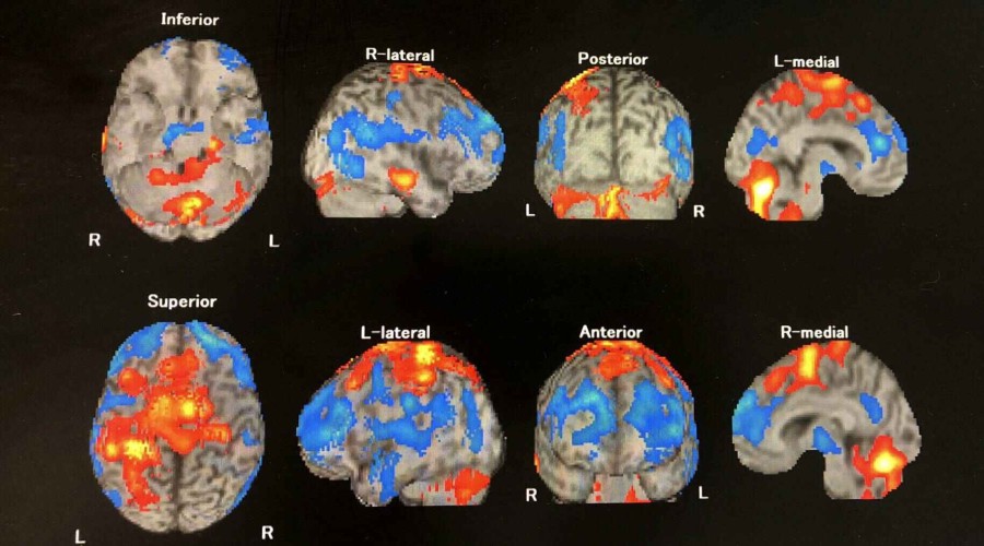 Covid May Cause Changes in the Brain, New Study Finds