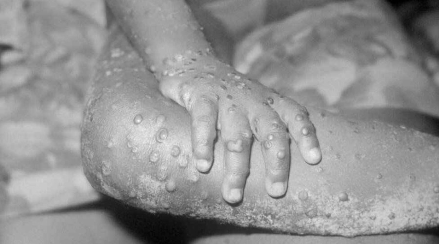 Cases of Monkeypox are being investigated in several European countries