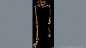 Ən qədim amputasiya olunmuş insanın skeleti tapıldı