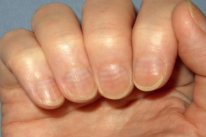 Внешний вид ногтей иногда указывает на больную щитовидную железу