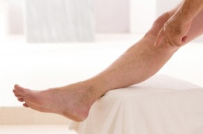 Внезапные судороги ног могут означать варикоз