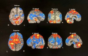 Covid May Cause Changes in the Brain, New Study Finds