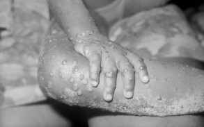 Turkiye detects first case of monkeypox